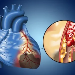 HEARTS ACS – from STEMI to Occlusion MI